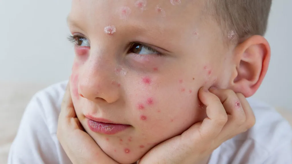 Chickenpox vaccine eligibility and symptoms explained