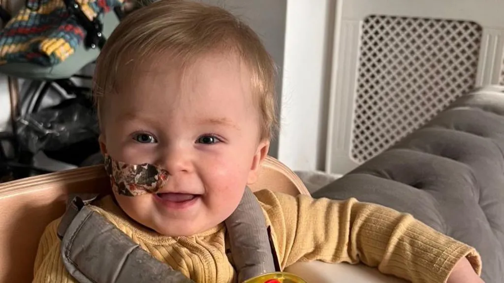 A little boy smiling at the camera. He has a nose tube covered by a plaster. He is strapped into a high chair and has a yellow long-sleeved top on.