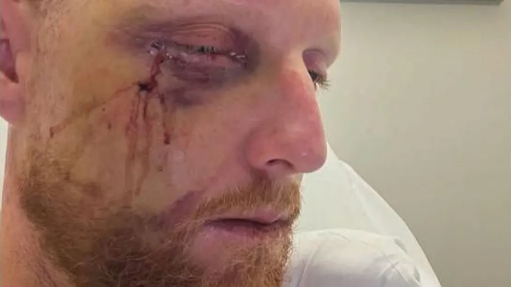 England's Stokes undergoes successful surgery for broken cheek